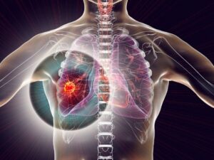 image-agciyer_xercengi_cancer