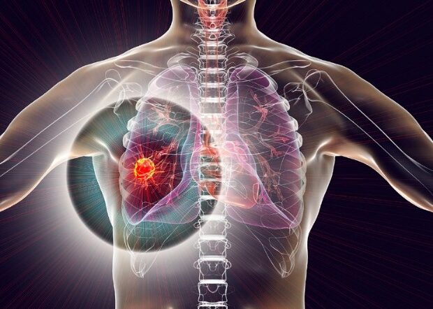 image-agciyer_xercengi_cancer